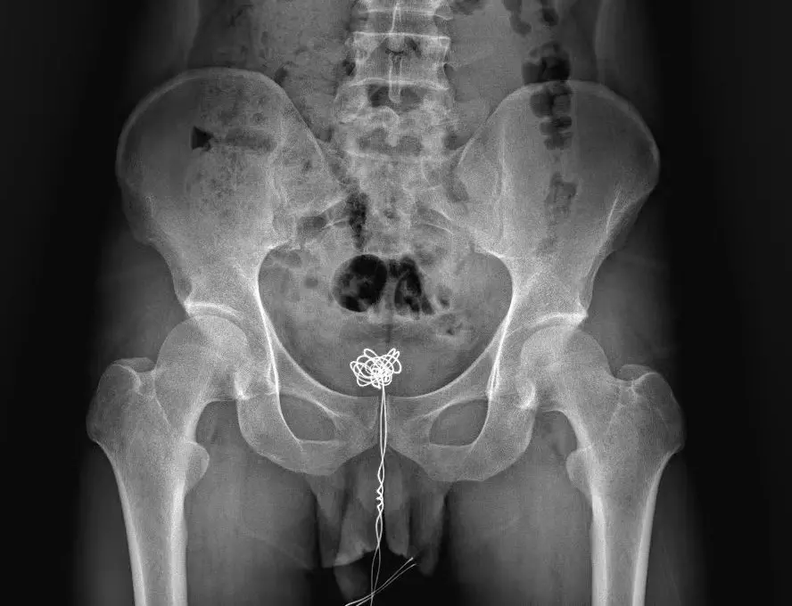 “痛”!男子往尿道塞入25cm长数据线,硬撑12小时